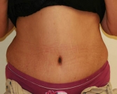 Feel Beautiful - Tummy Tuck Case 28 - After Photo